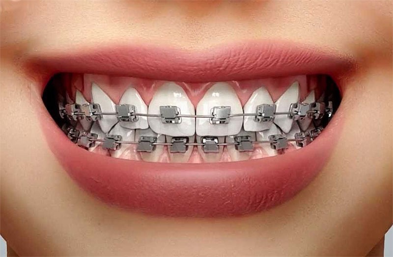 металлические брекеты металлические брекеты