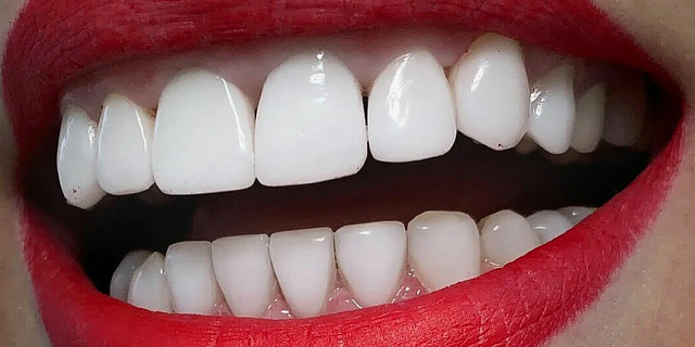 Виниры Виниры