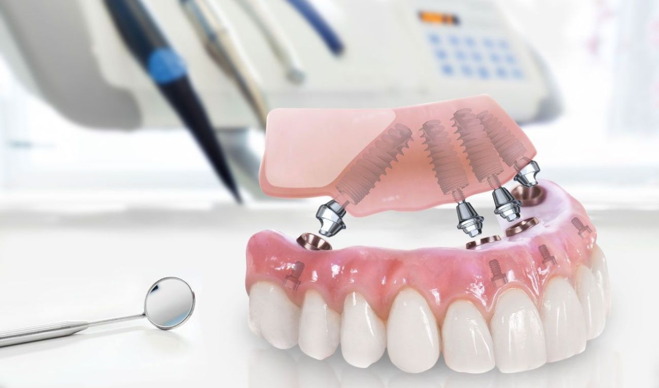 Имплантация методом All-on-4 за 1 день Имплантация методом All-on-4 за 1 день