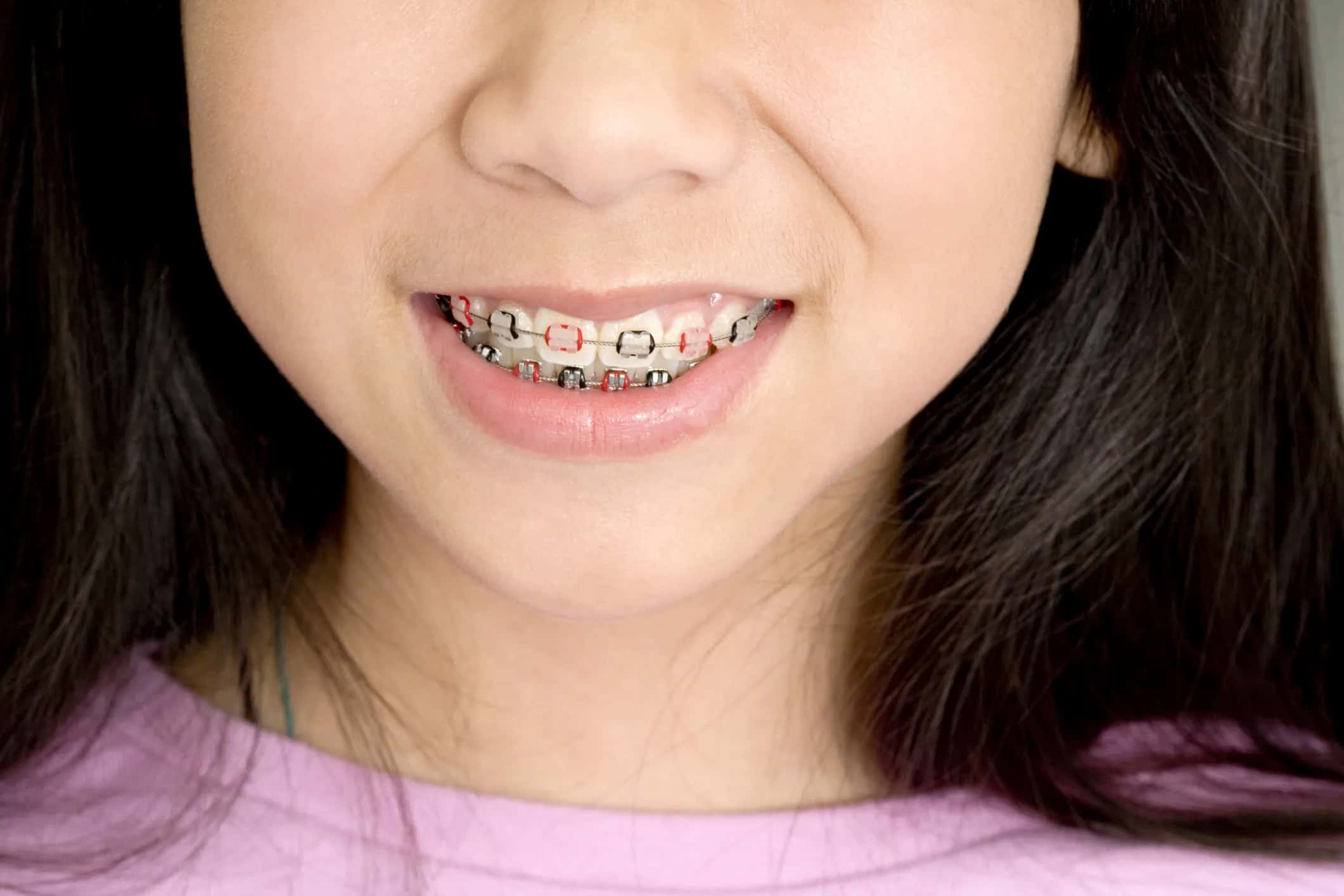 Уход за брекетами и винирами во время лечения Уход за брекетами и винирами во время лечения