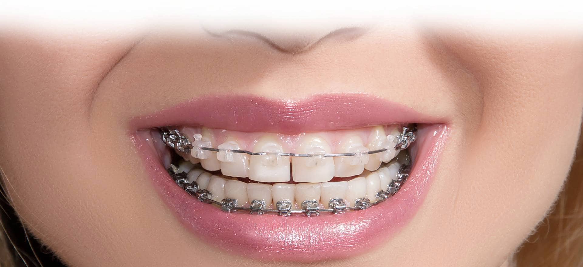 Стоимость установки брекетов Стоимость установки брекетов