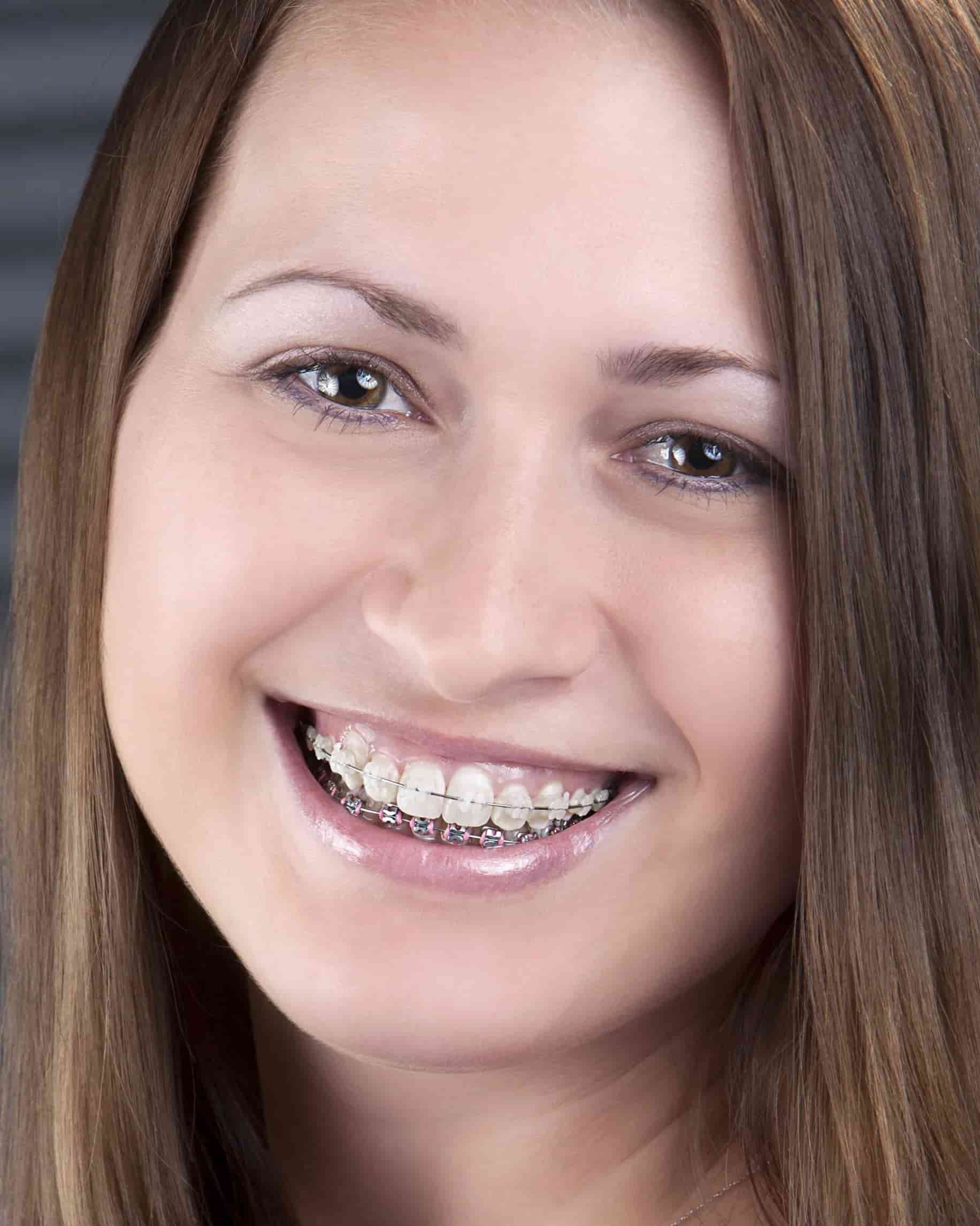 Возможные трудности и адаптация к брекетам Возможные трудности и адаптация к брекетам