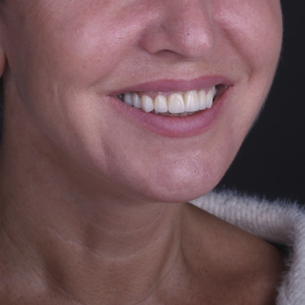 Циркониевые коронки — кейс Циркониевые коронки — кейс