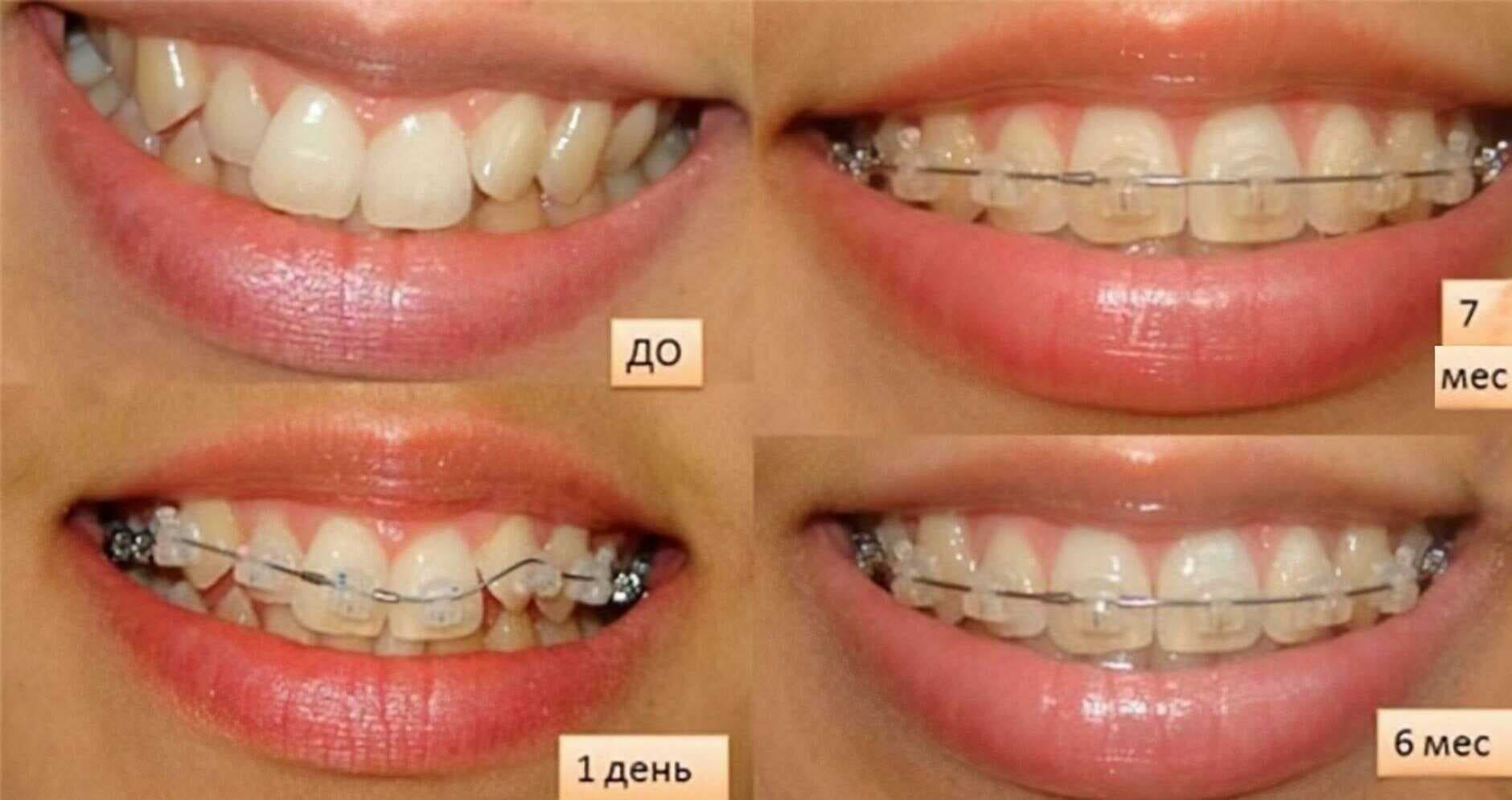 Сколько носить брекеты Сколько носить брекеты