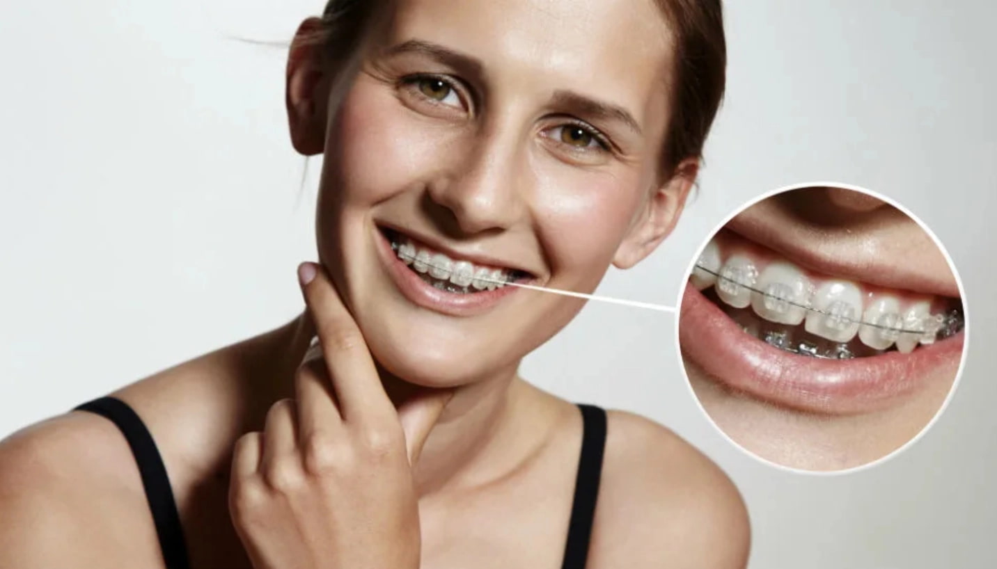 Как выбрать подходящий вид брекетов Как выбрать подходящий вид брекетов