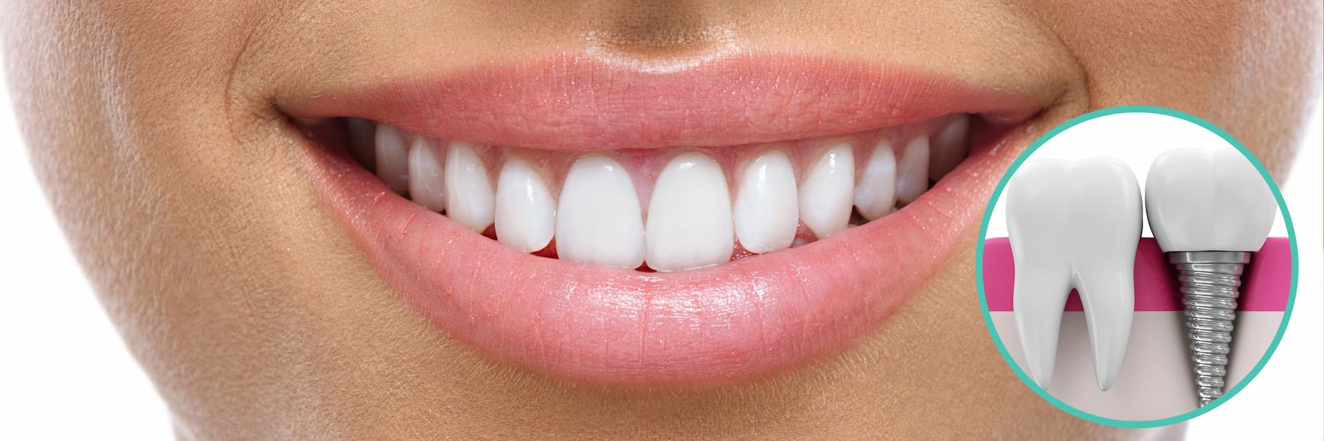 Какие импланты выбрать Какие импланты выбрать