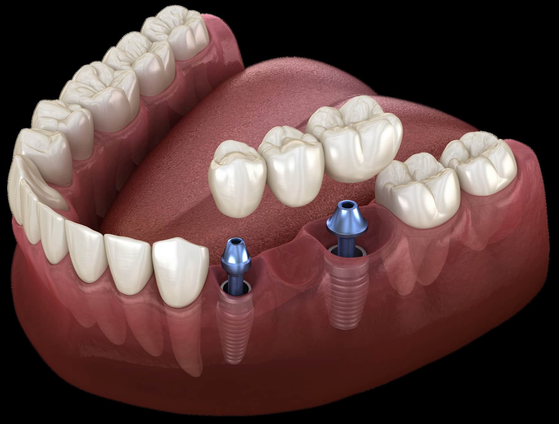 Мост на двух имплантах Мост на двух имплантах