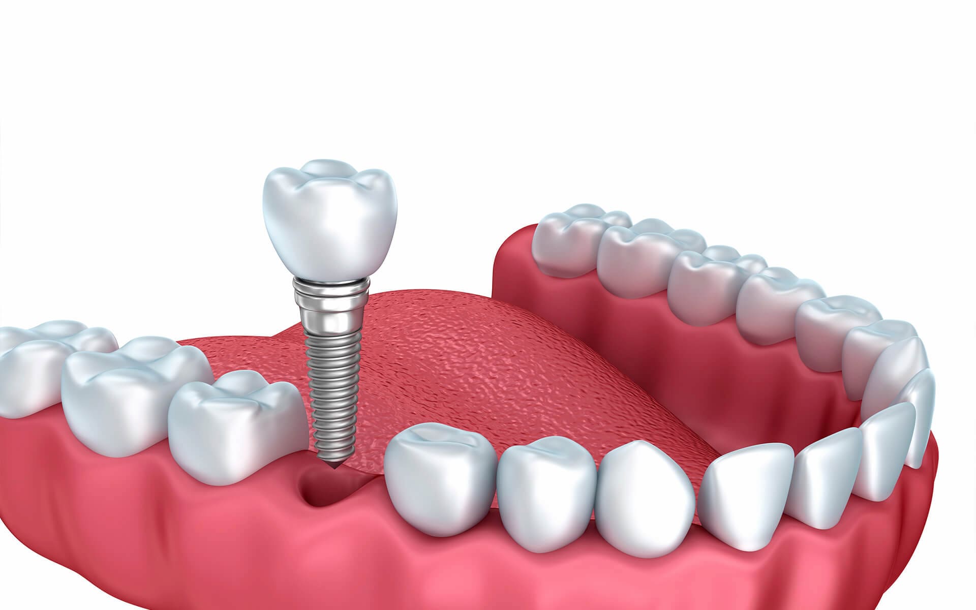 Сложности при имплантации шестого зуба Сложности при имплантации шестого зуба