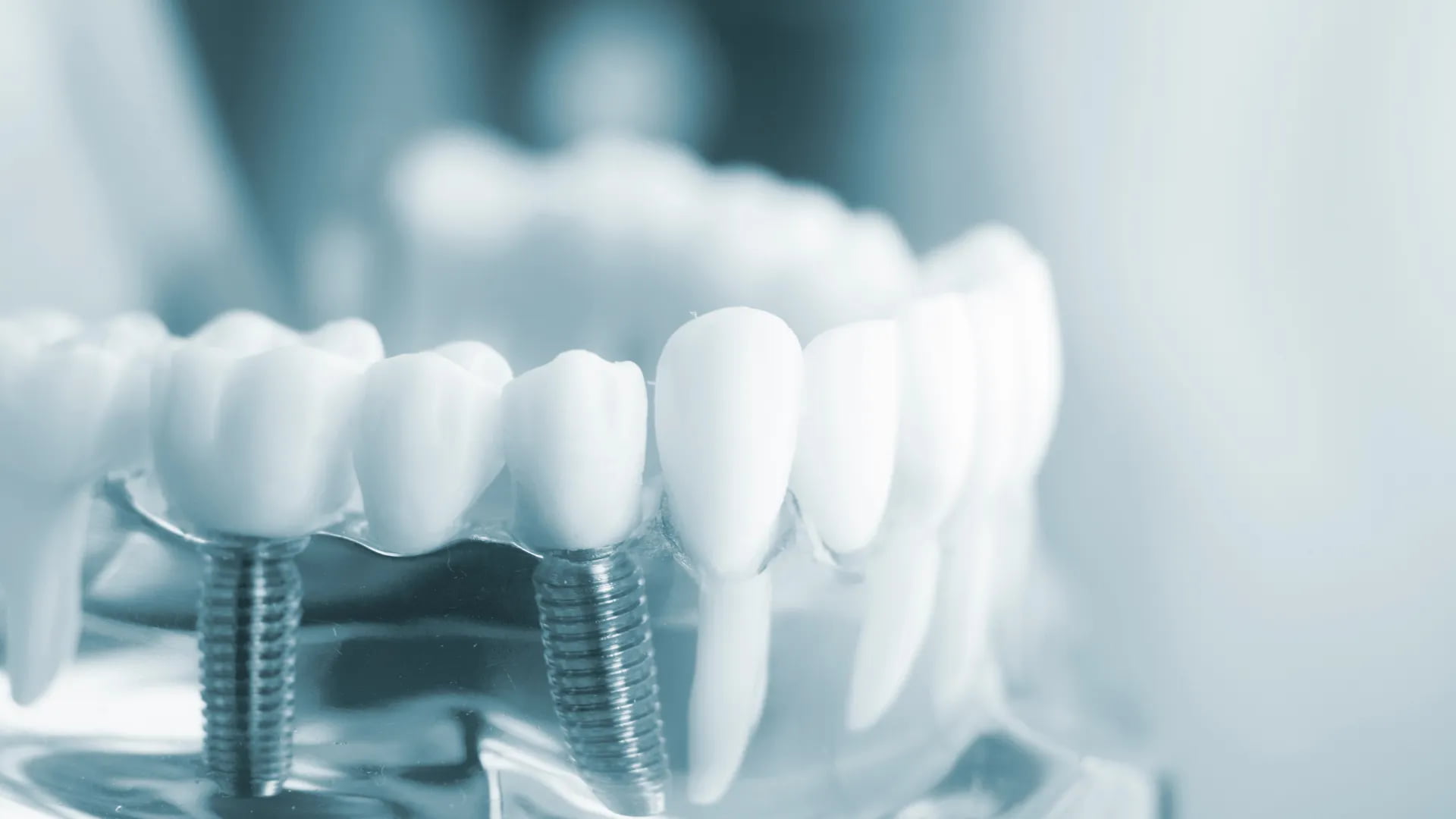 Особенности имплантации 7 верхнего и нижнего зуба Особенности имплантации 7 верхнего и нижнего зуба