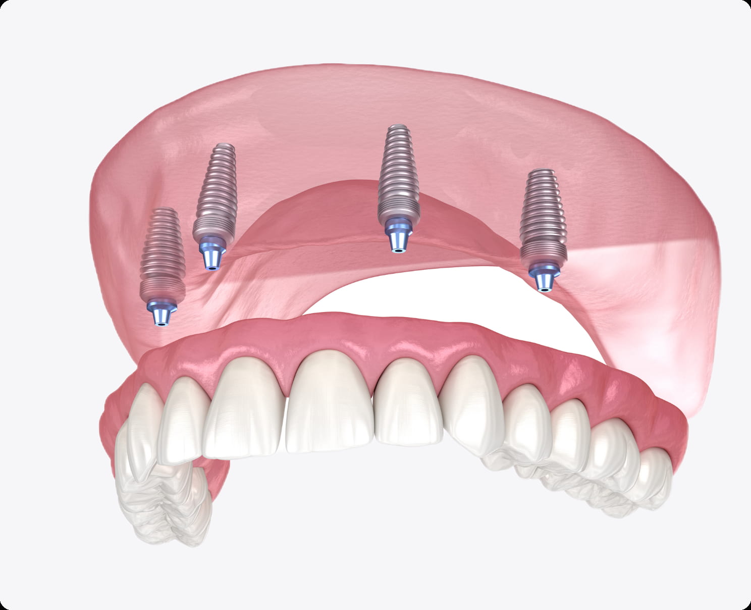 Возможные противопоказания Возможные противопоказания