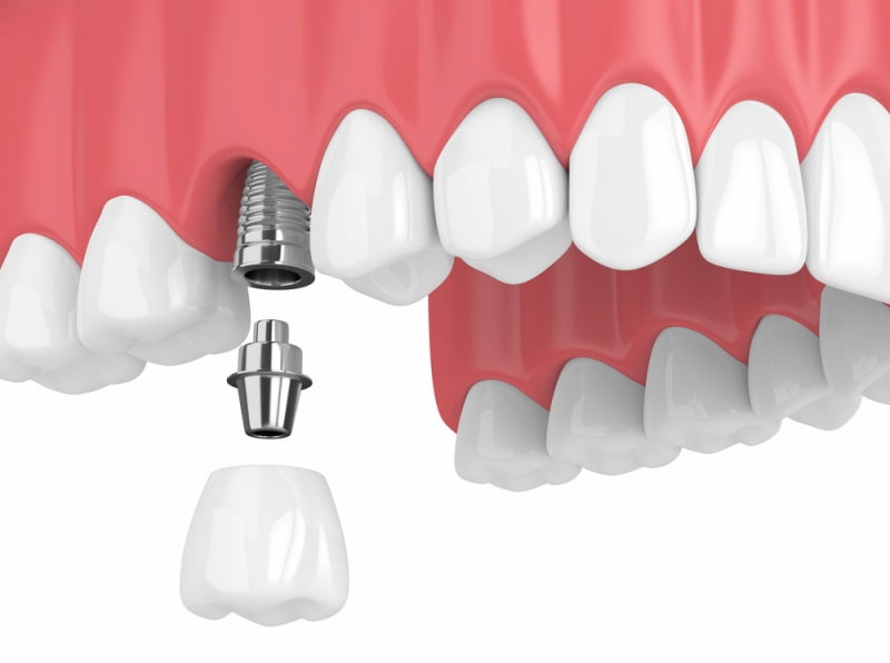 Как выбрать имплант Как выбрать имплант