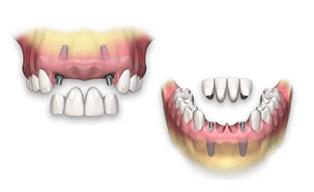 Когда используют мост на 2 имплантах Когда используют мост на 2 имплантах