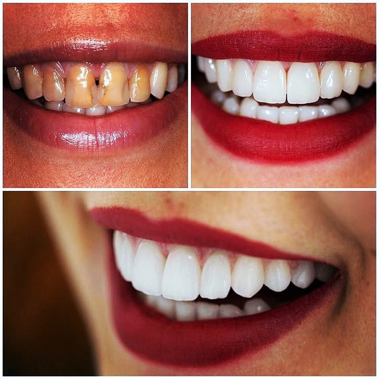 В каких случаях устанавливают виниры