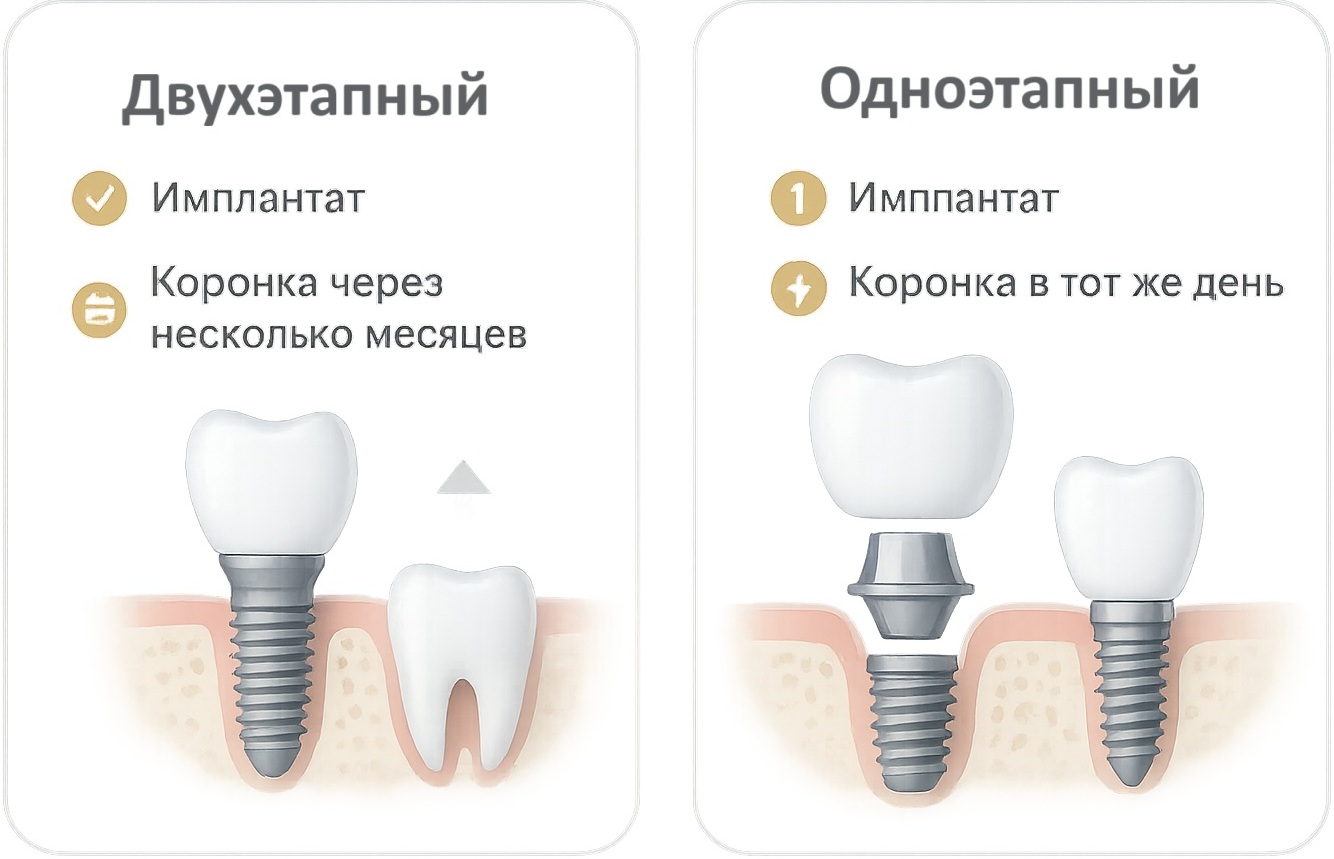 два вида одномоментной имплантации два вида одномоментной имплантации