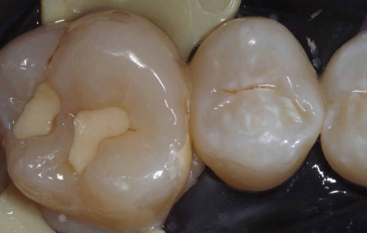 До комплексного лечения жевательного отдела