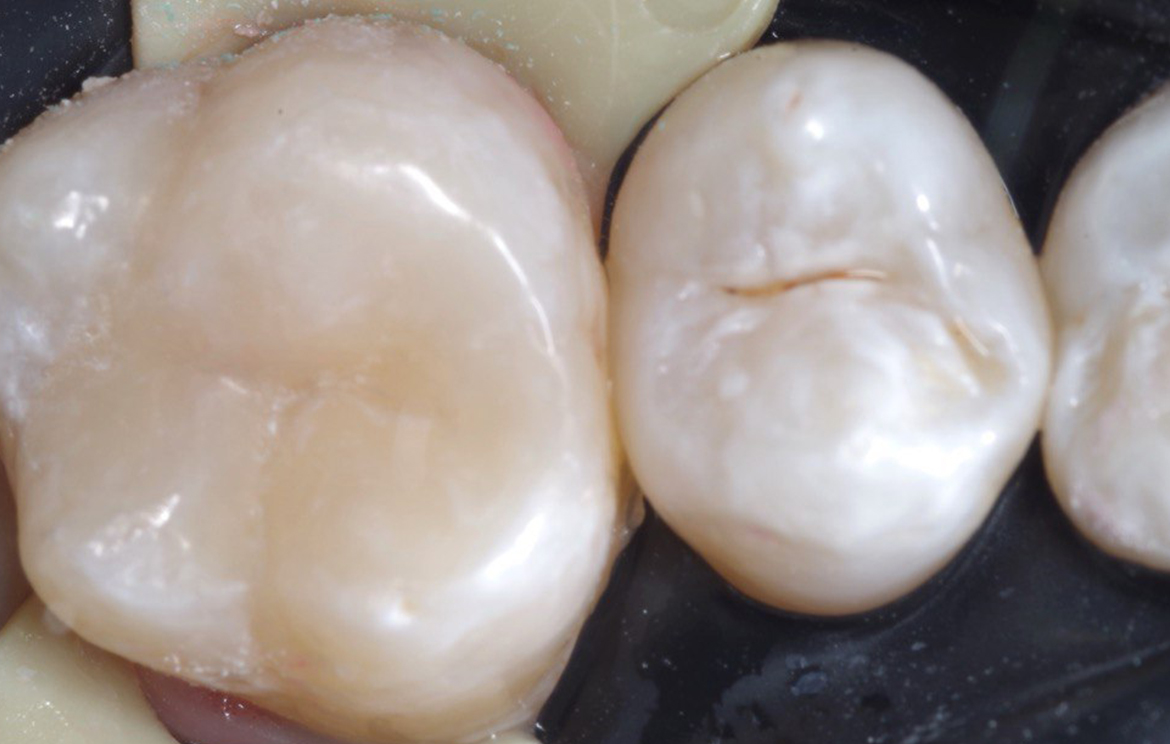 После восстановления 4.7 и планирования имплантации