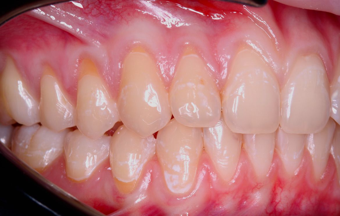 Оголение корней зубов