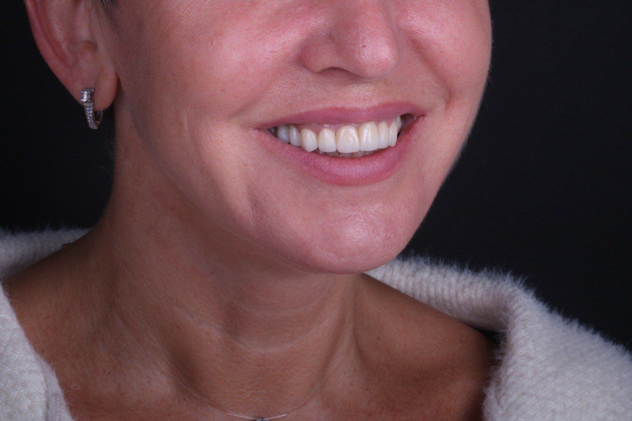 Циркониевые коронки — результат протезирования