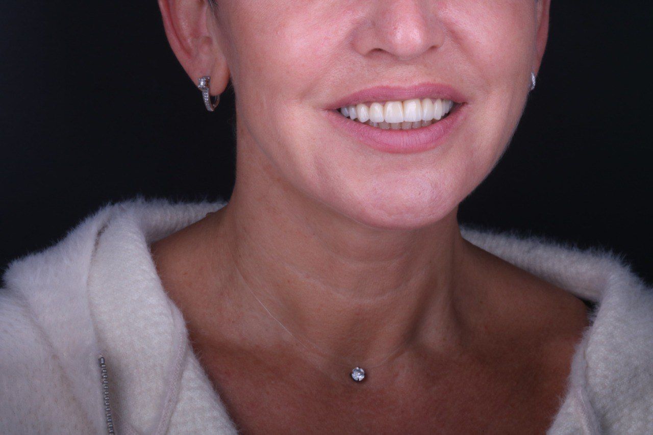 Циркониевые коронки — улыбка пациента