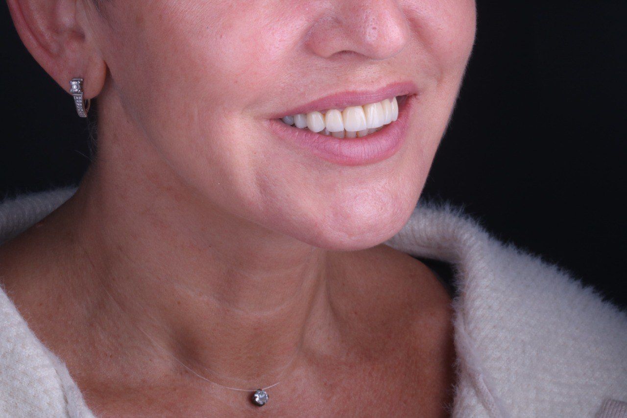 Циркониевые коронки — вид сбоку