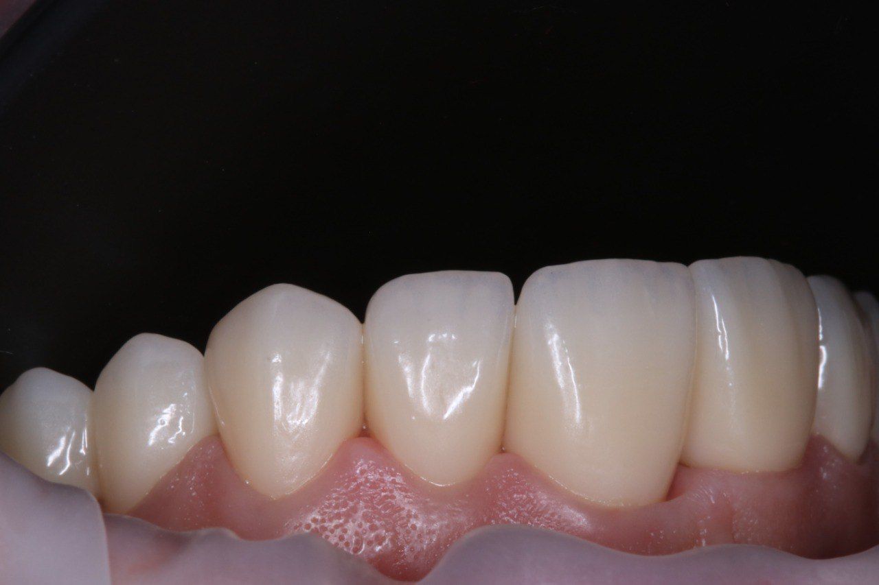 Циркониевые коронки — фронтальная группа