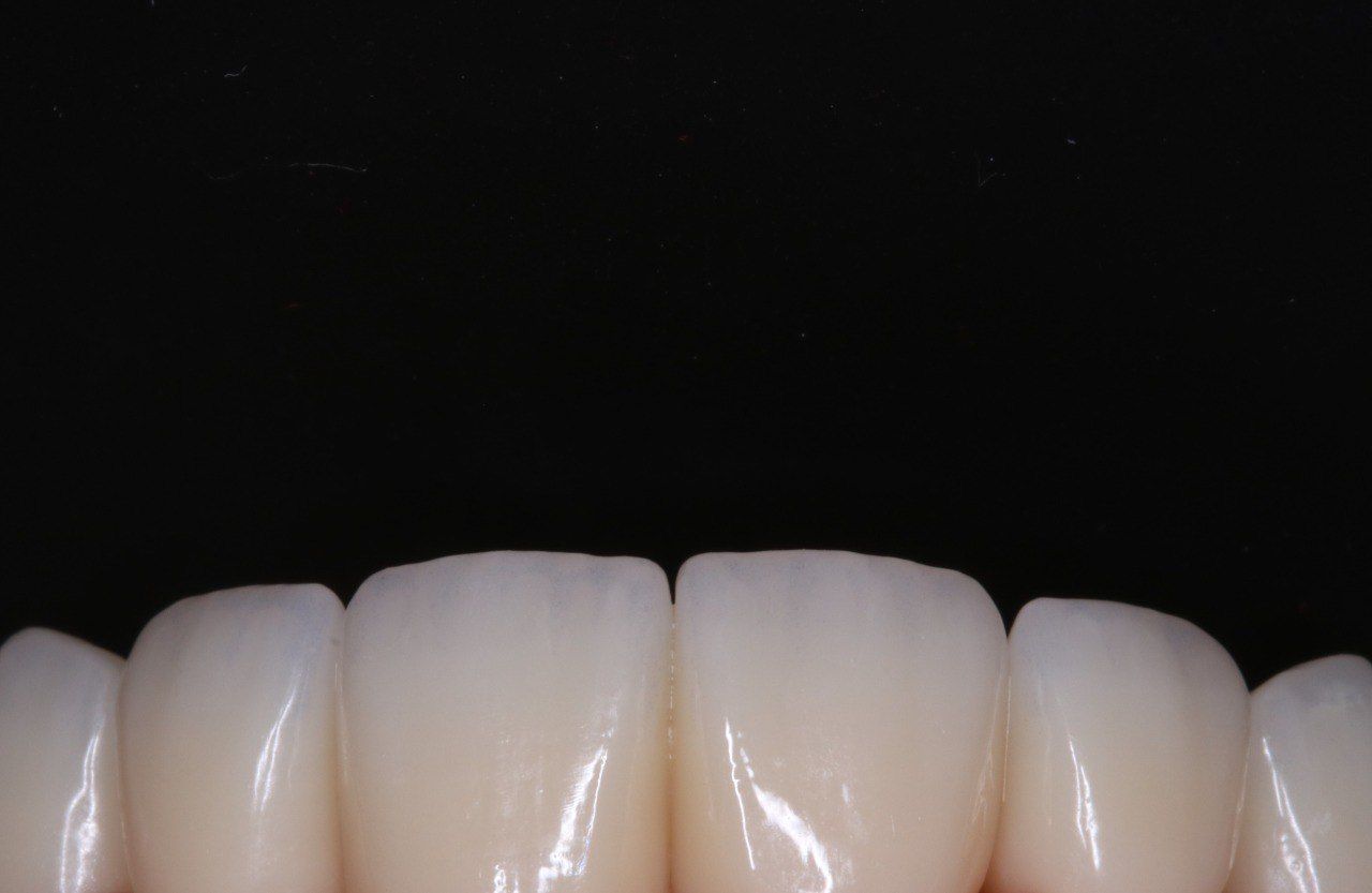Циркониевые коронки — крупный план