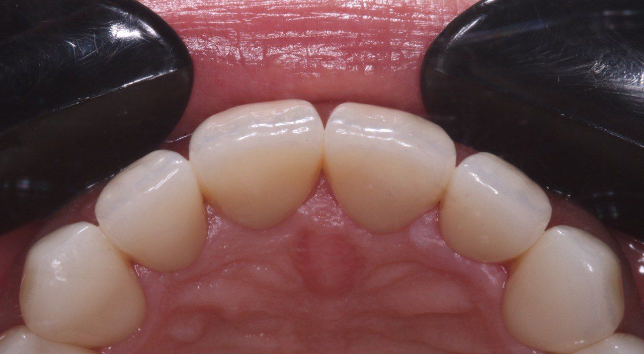 Циркониевые коронки — результат