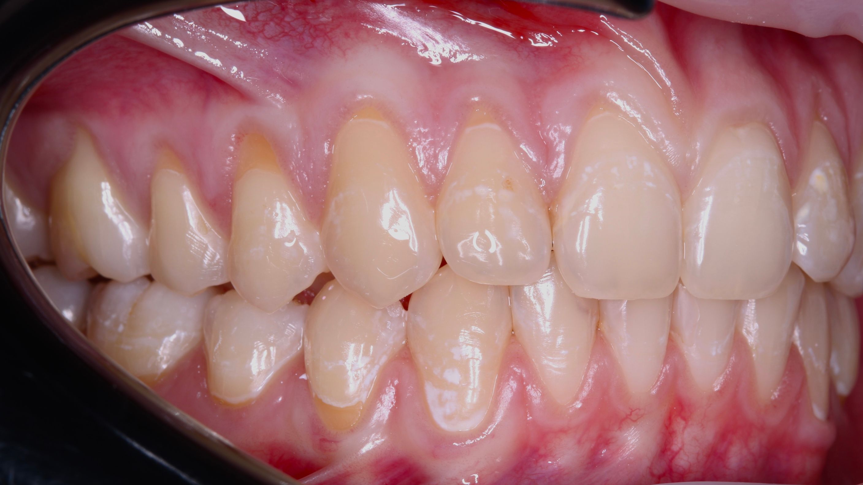 Рецессия десны — до лечения