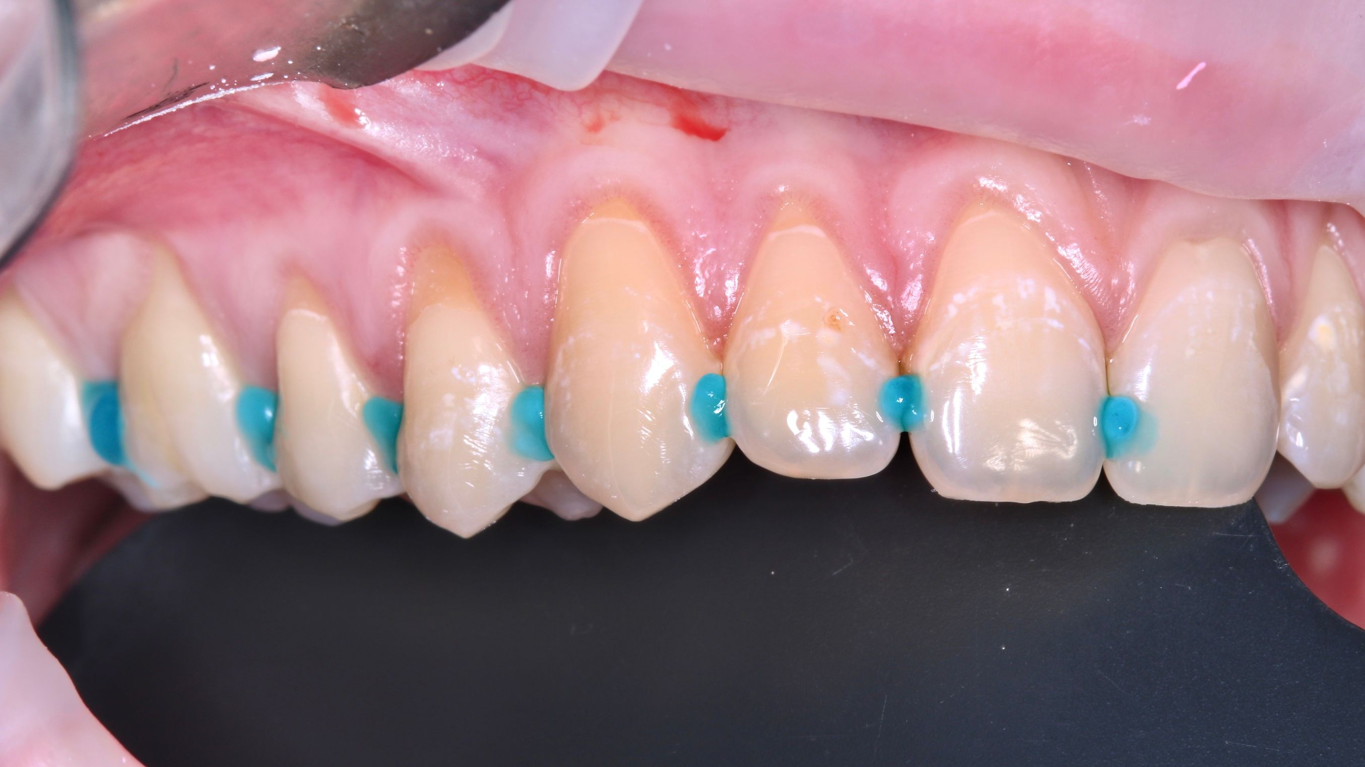 Циркониевые коронки — улыбка пациента