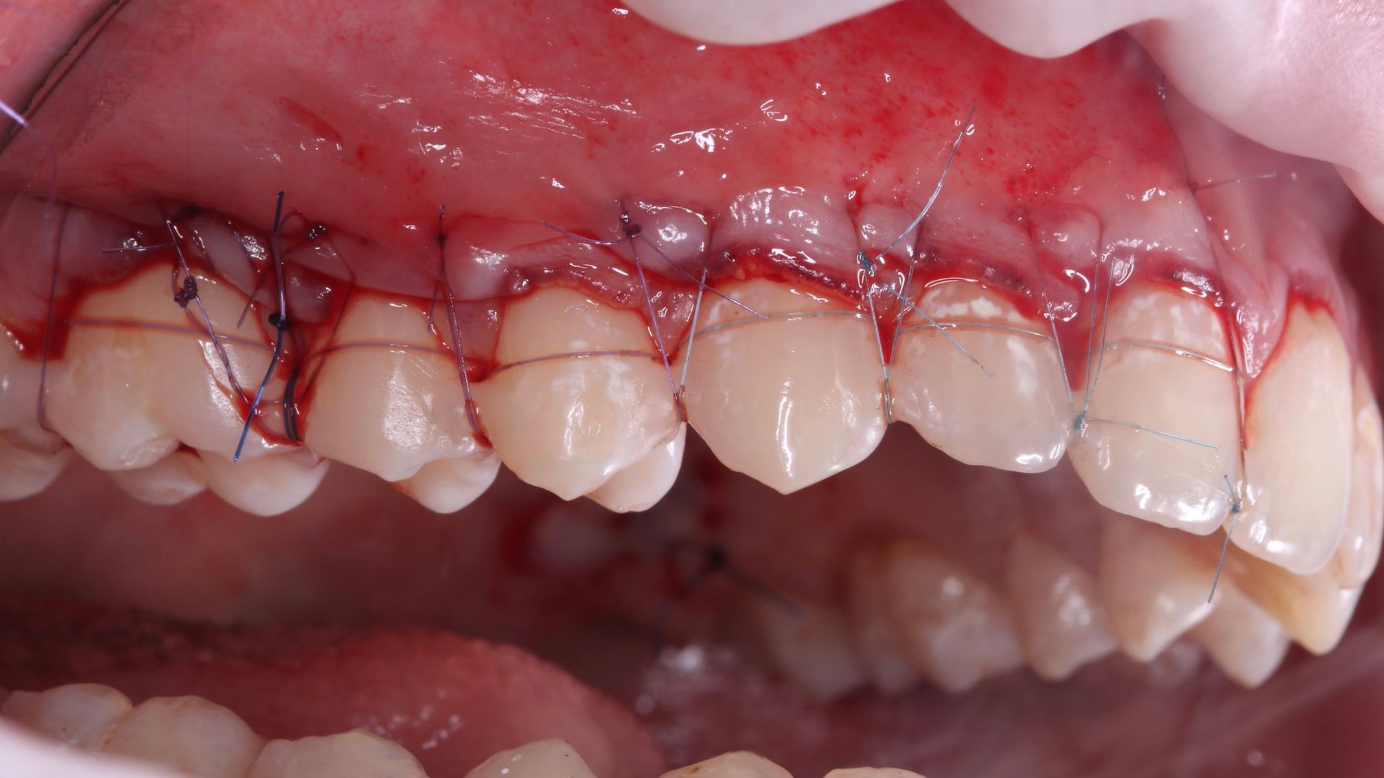 Циркониевые коронки — вид сбоку