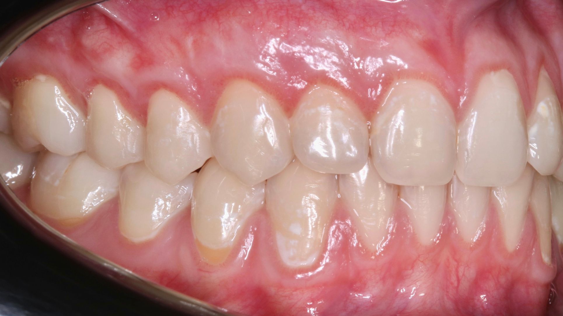 Циркониевые коронки — фронтальная группа