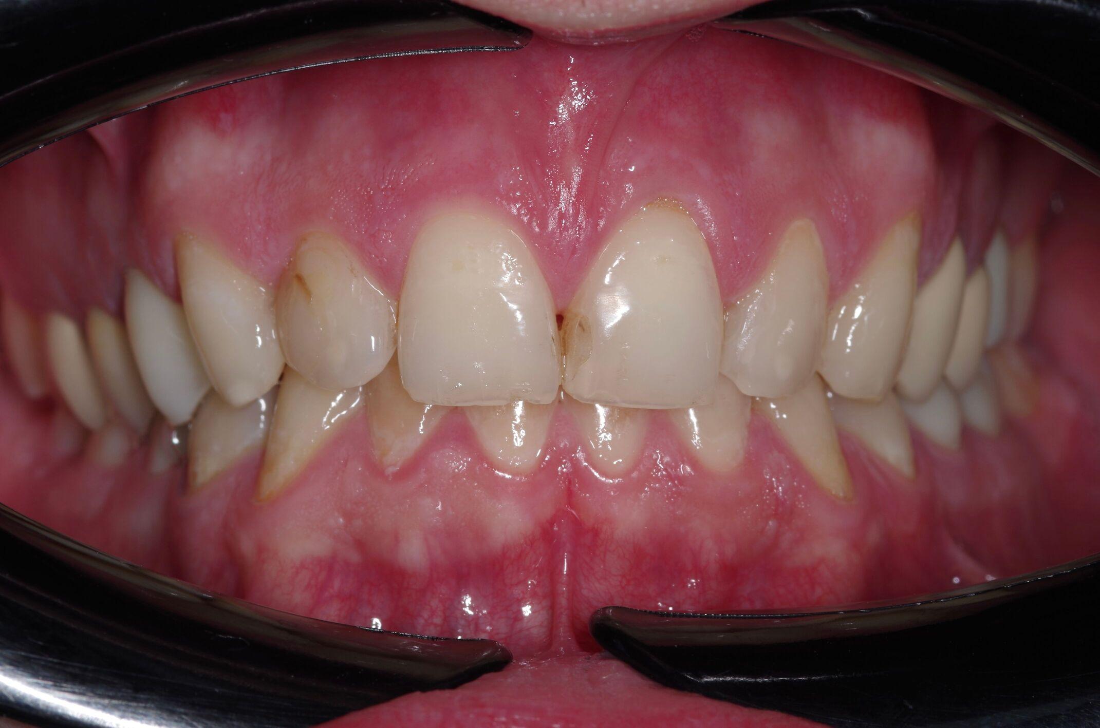 Керамические виниры — до лечения