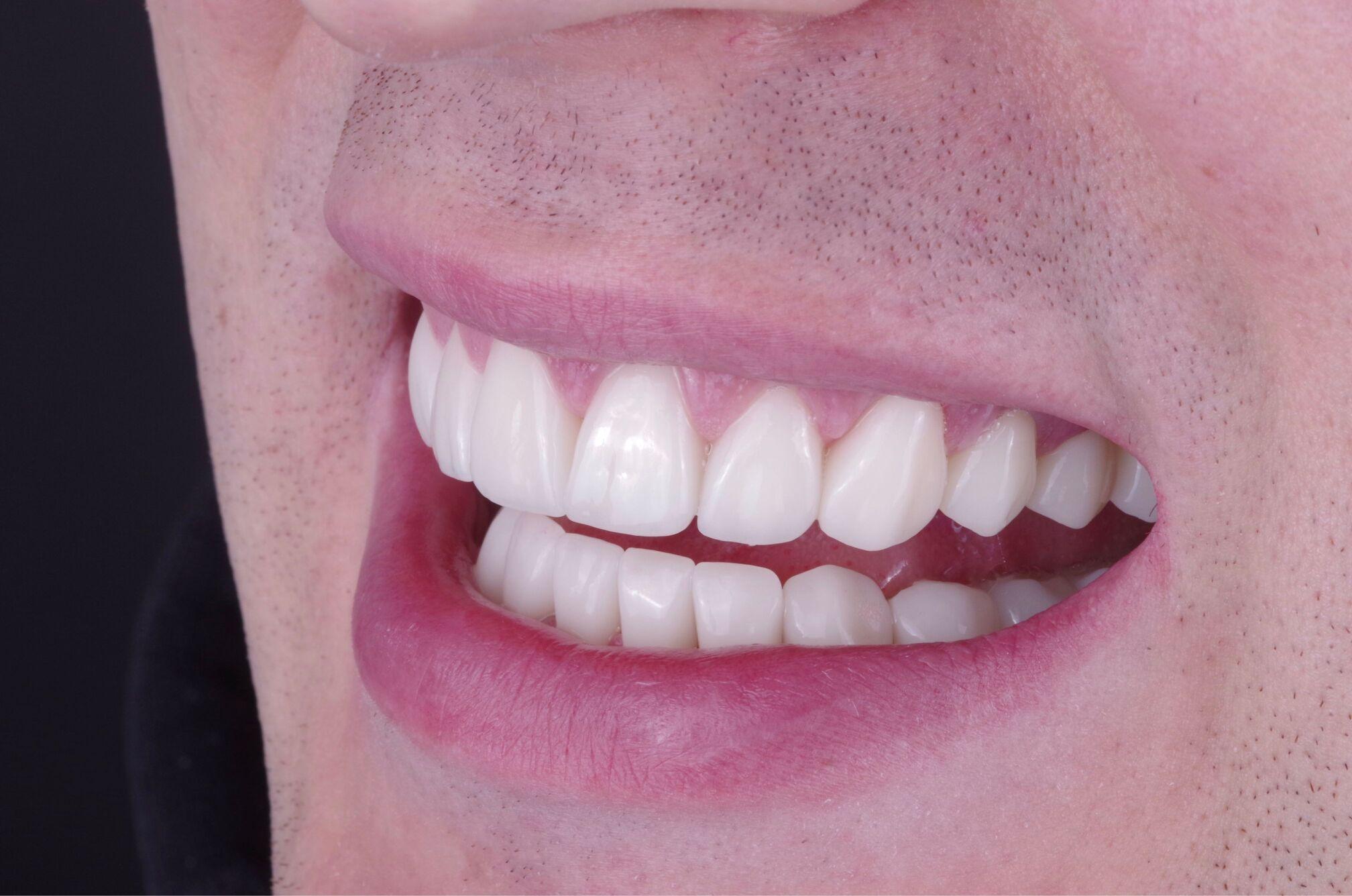 Керамические виниры — красивый результат