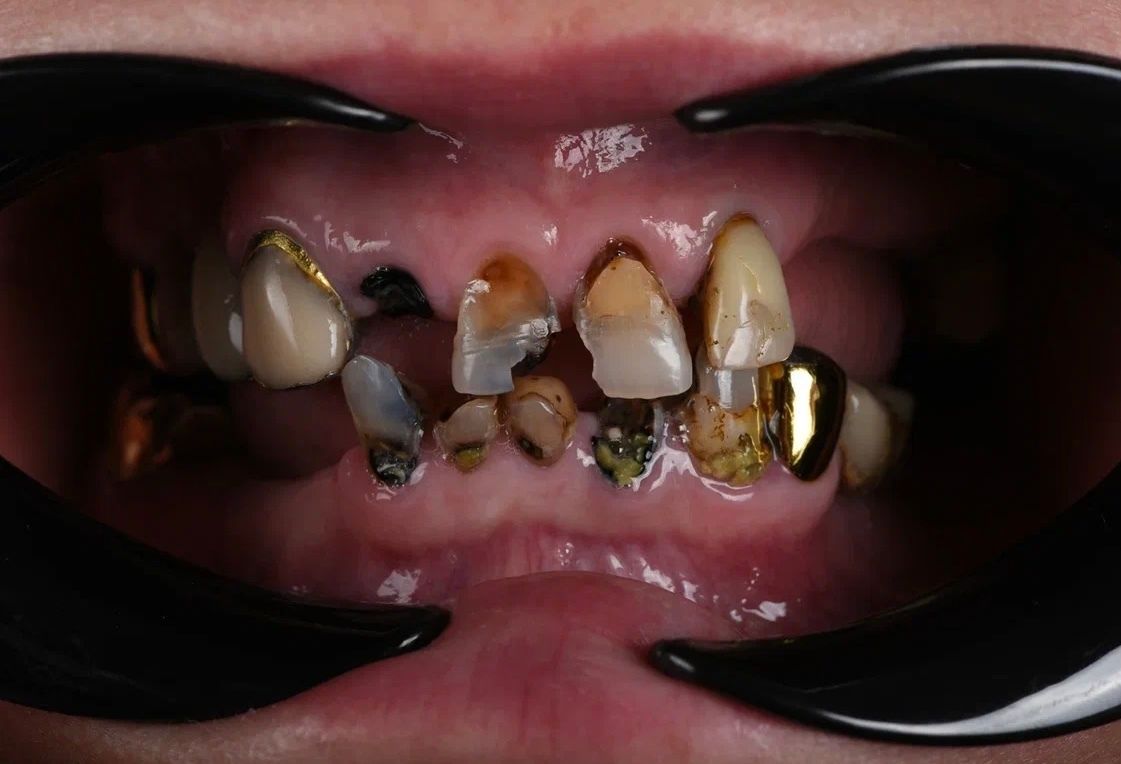 Полная имплантация зубов — панорамный снимок до и после лечения