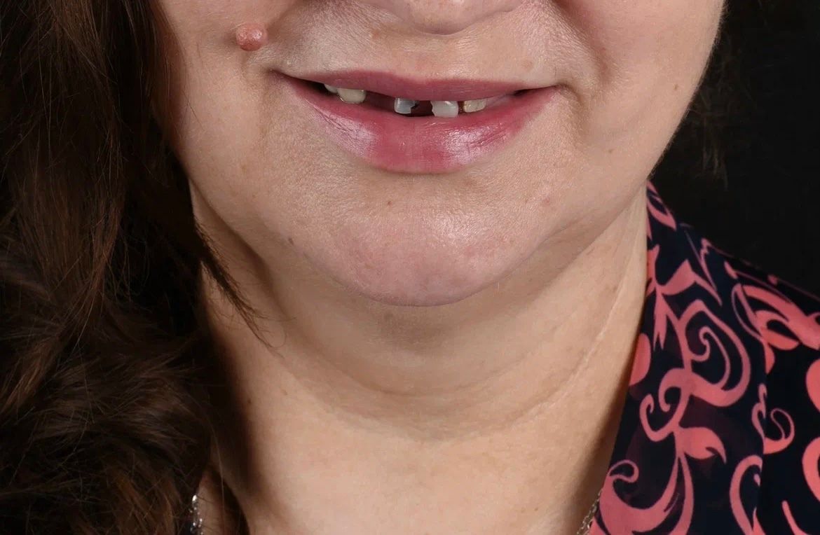 Полная имплантация — состояние полости рта до лечения