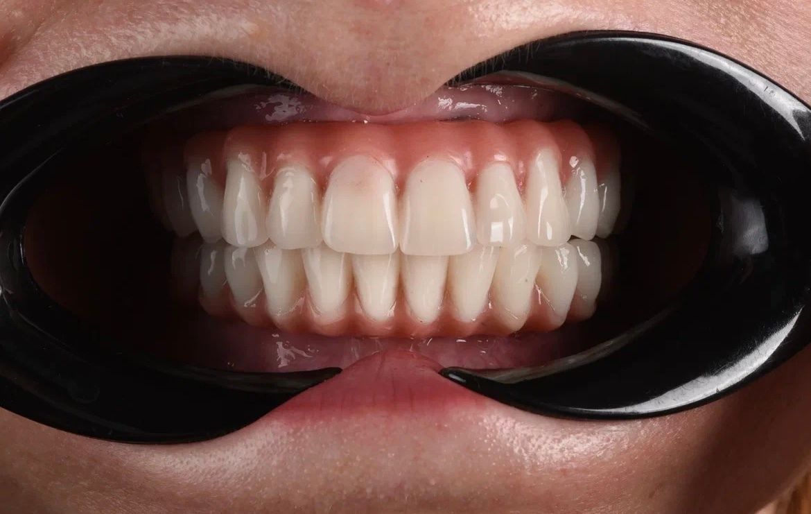 Полная имплантация — вид после установки имплантатов Osstem