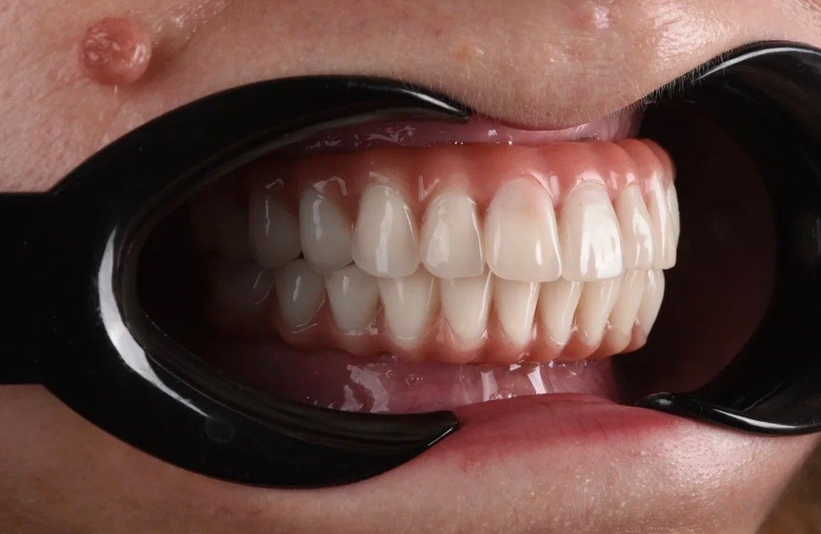 Полная имплантация — временный несъёмный протез на верхней челюсти