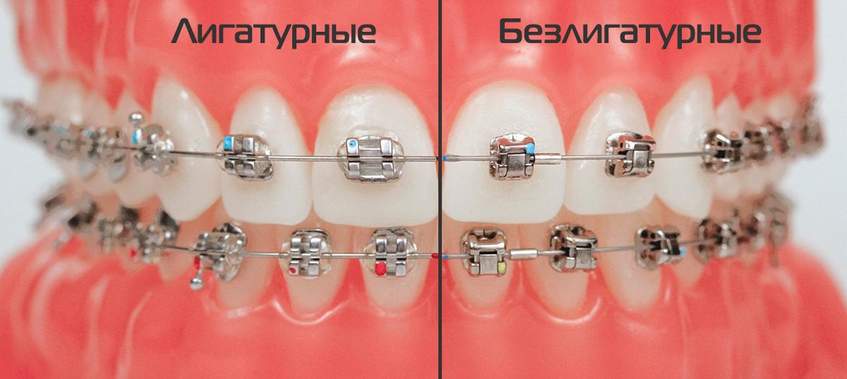 брекеты из керамики брекеты из керамики