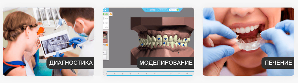 Изготовление элайнеров Flexilinger Изготовление элайнеров Flexilinger