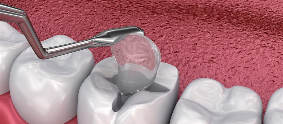 Герметизация фиссур зубов Герметизация фиссур зубов