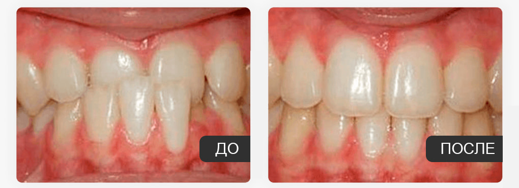 Как работают элайнеры Flexiligner? Как работают элайнеры Flexiligner?