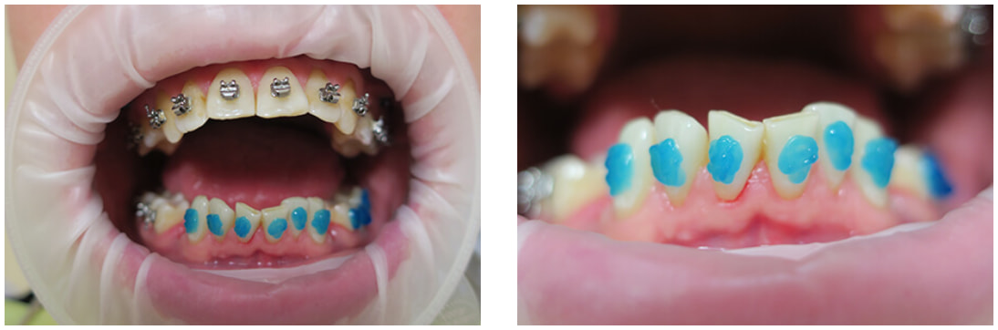 Нанесение клея и установка брекетов Нанесение клея и установка брекетов