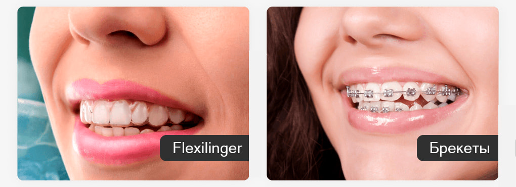 Преимущества элайнеров Flexilinger Преимущества элайнеров Flexilinger