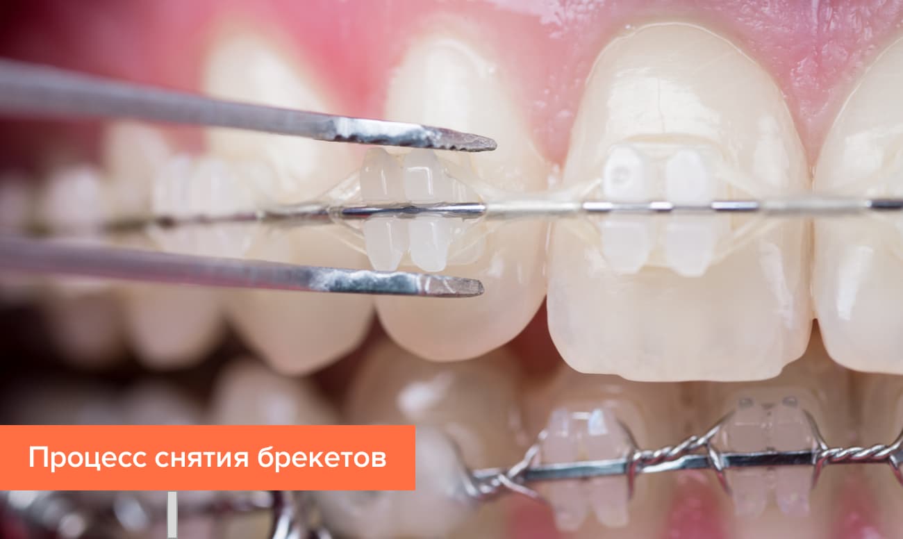 Процесс снятия брекетов Процесс снятия брекетов