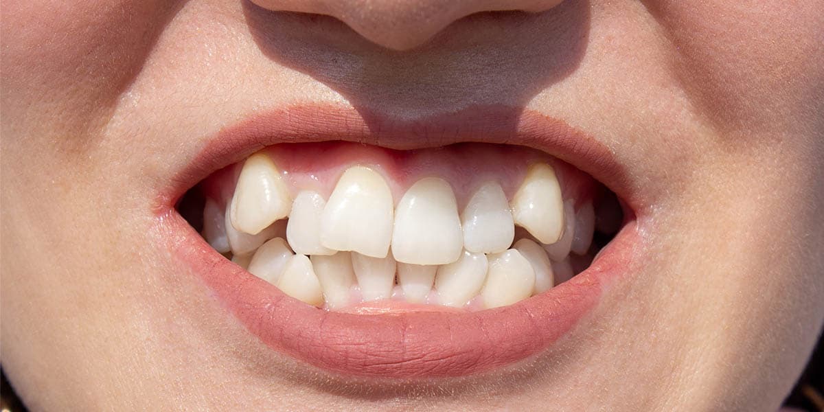 Скученность зубов Скученность зубов