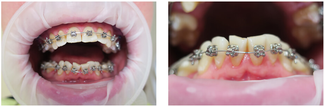 Установка ортодонтической дуги Установка ортодонтической дуги