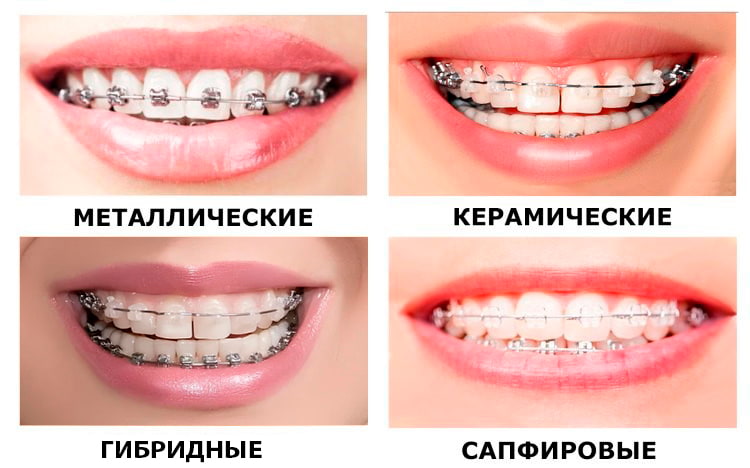 Виды брекетов