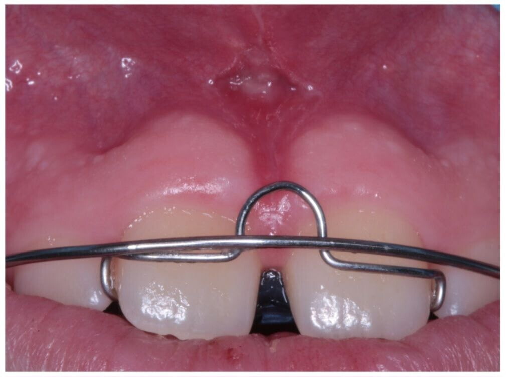 История кейса: пластики уздечки верхней губы История кейса: пластики уздечки верхней губы