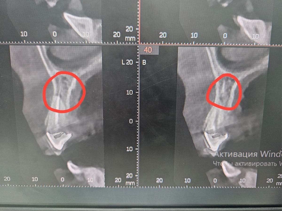 Спасли зуб от удаления! Спасли зуб от удаления!