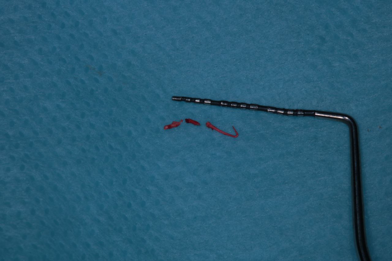 Спасли зуб от удаления! Спасли зуб от удаления!